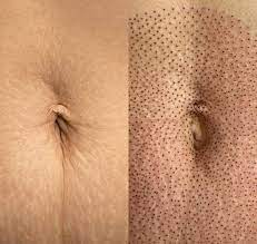 Avantage chirurgie relachement cutané perte poids